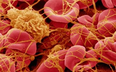 Worldwide Embalmer Survey: 250 Embalmers Report Finding White Rubbery Clots