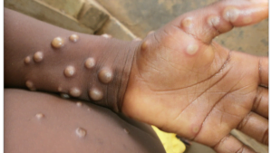 Monkeypox lesions