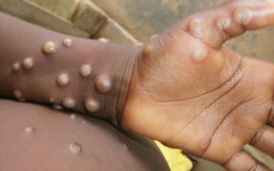 Is The Ruling Class Creating a “False Demand” For Monkeypox Vaccines?