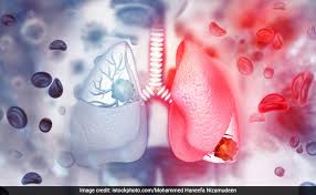 Children All Over The United States Are Starting To Develop “White Lung Syndrome”